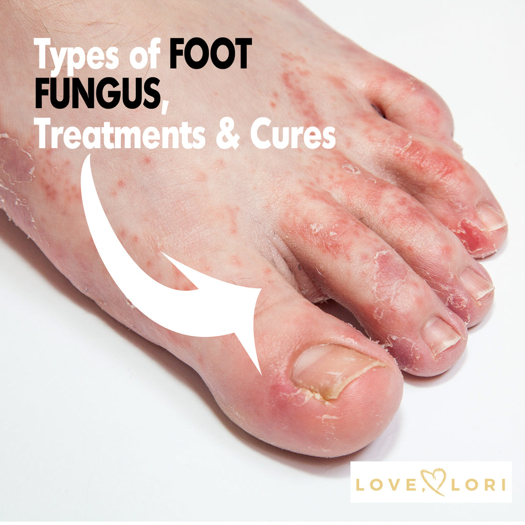 Types of Foot Fungus — Athlete's Foot Symptoms and Treatment – Love, Lori