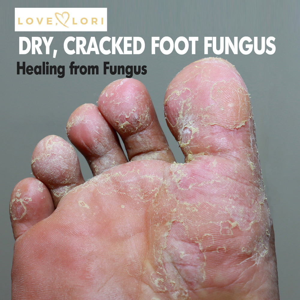 Dry Cracked Feet Fungus, Toenail Fungus, and Athlete's Foot Cures