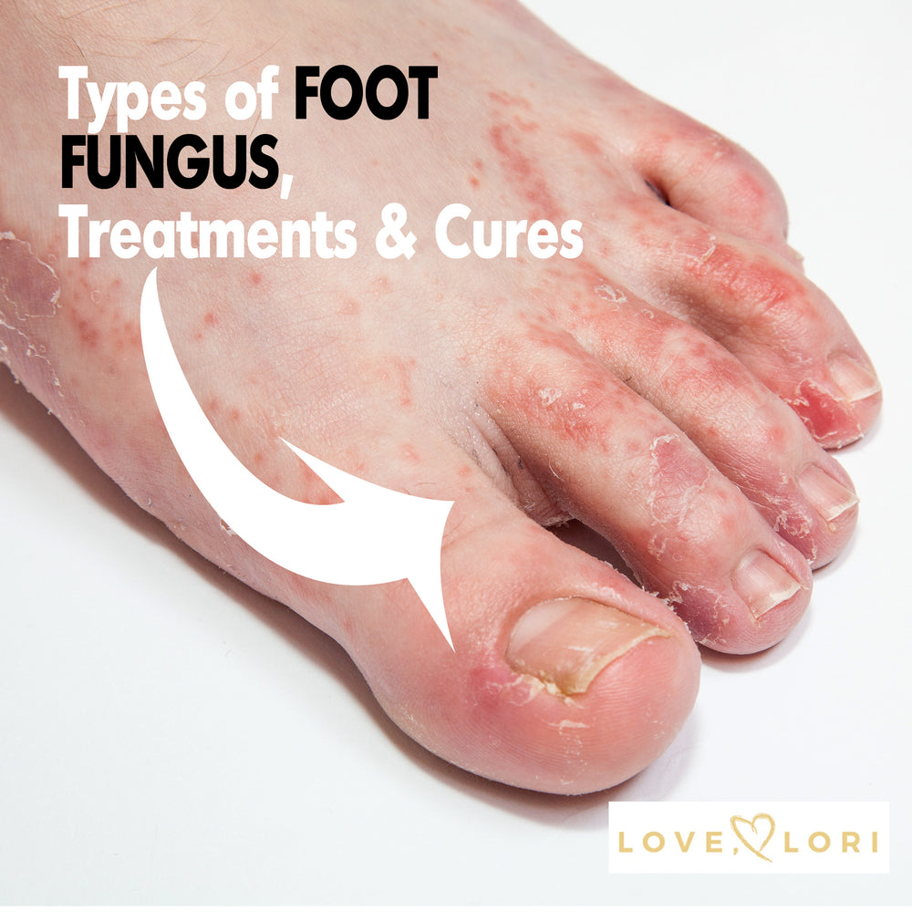 Types of Foot Fungus — Athlete’s Foot Symptoms and Treatment