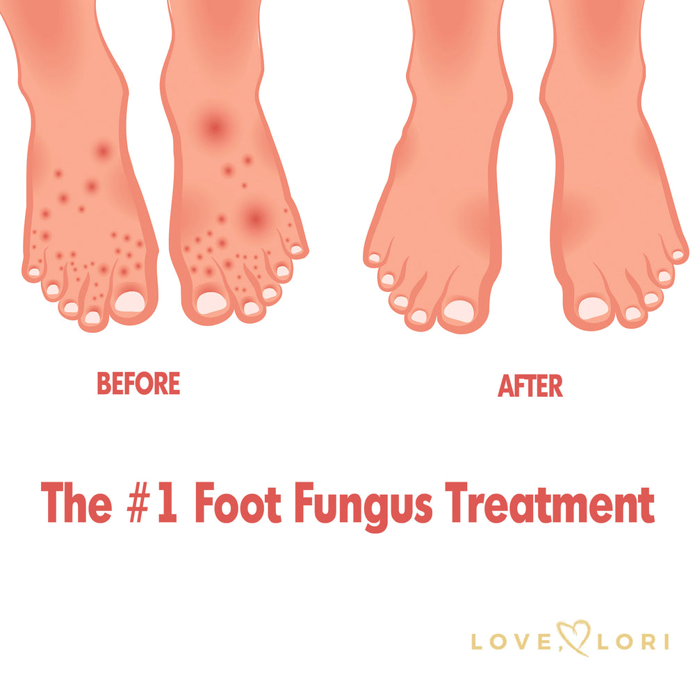 The #1 Foot Fungus Treatment for Symptom Relief
