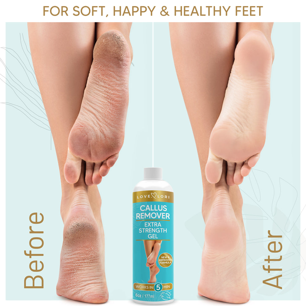 
            
                Load image into Gallery viewer, Foot Callus Remover Gel 6oz By Love, Lori - Callus Remover For Feet &amp;amp; Dead Skin Remover For Feet - Works With Foot Scrubber, Pumice Stone For Soft Feet - Professional Pedicure Results At Home
            
        